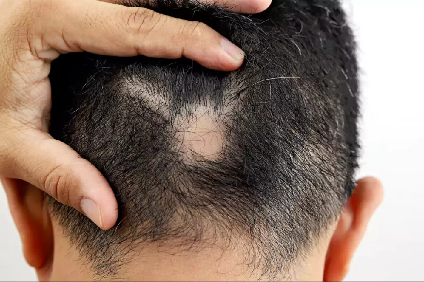 Triggers Hair Loss